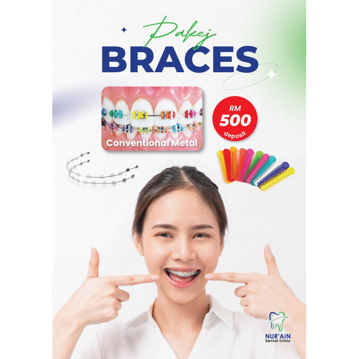Pemasangan Braces RM500 di Klinik Pergigian Nur Ain
